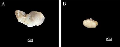 Angiofibroma of Soft Tissue: A Clinicopathological Study of Eight Cases With Emphasis on the Diagnostic Utility of Fluorescence In Situ Hybridization Detection for NCOA2 Rearrangement